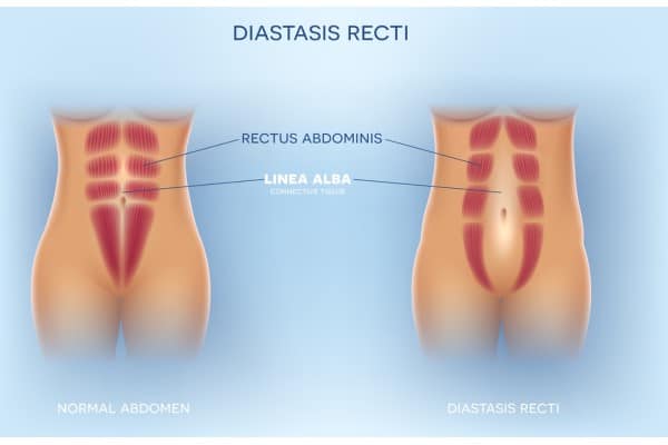 What Non-Surgical Options Are Available for Diastasis Recti Glasgow?