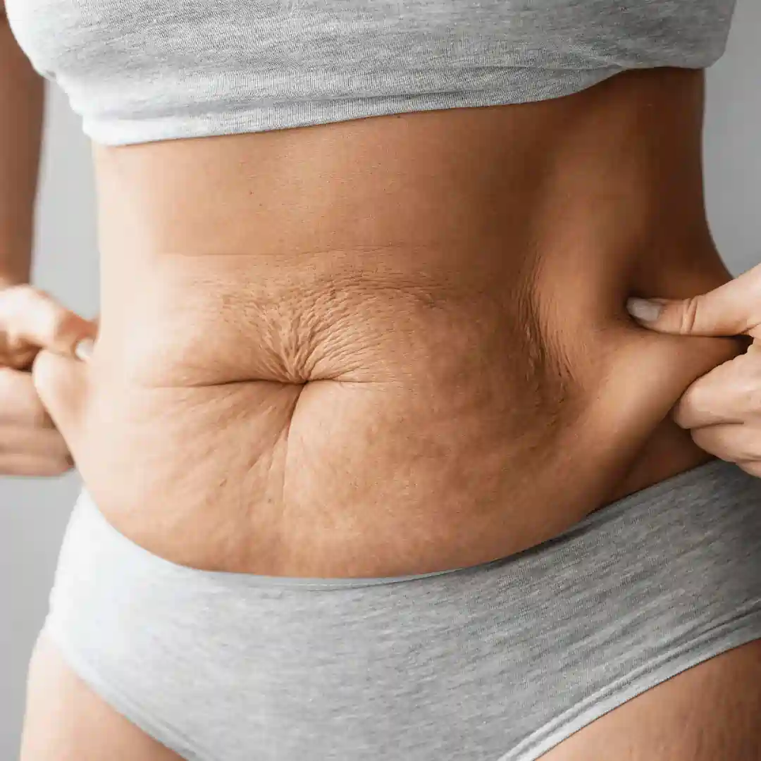 Is It Normal to Have Loose Skin After Pregnancy Glasgow?