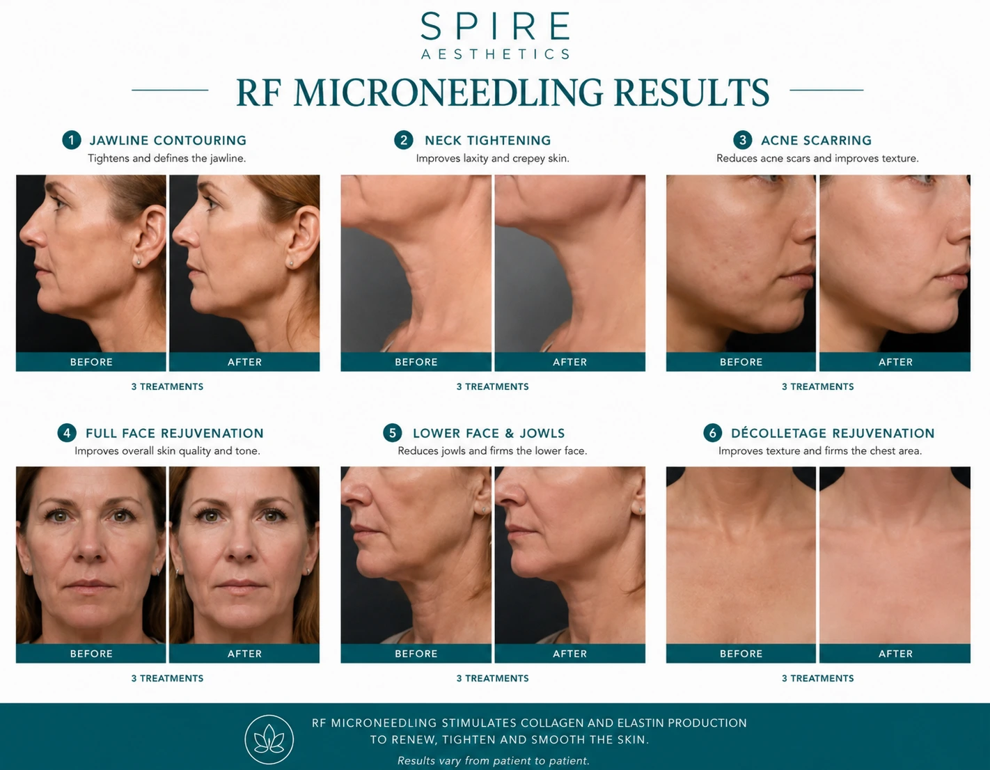 RF Microneedling Skin tightening Glasgow results