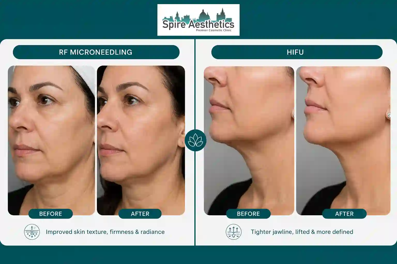 Can RF Microneedling and HIFU Be Combined Glasgow?
