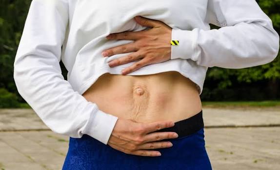 When Could Diastasis Recti Be the Missing Piece of the Puzzle Glasgow?