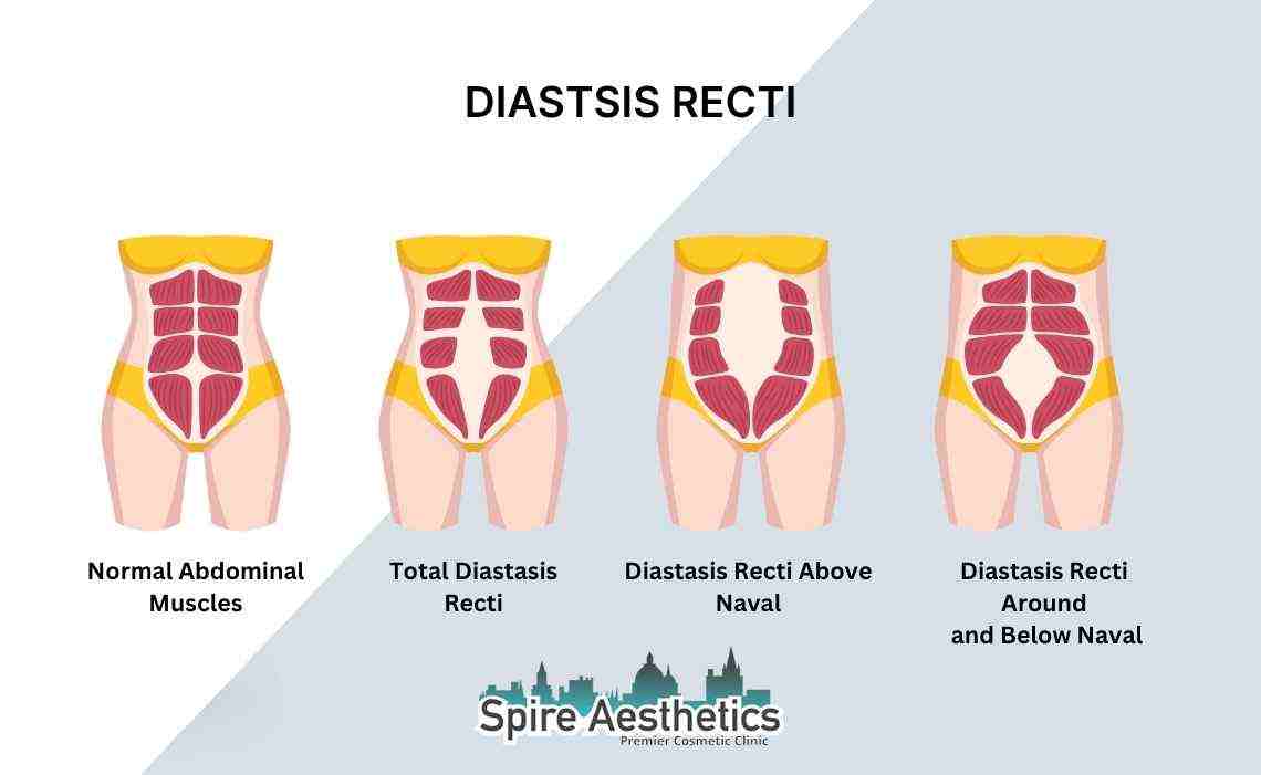 Is Non-Surgical Diastasis Recti Treatment Right for You? Common Concerns Answered Glasgow